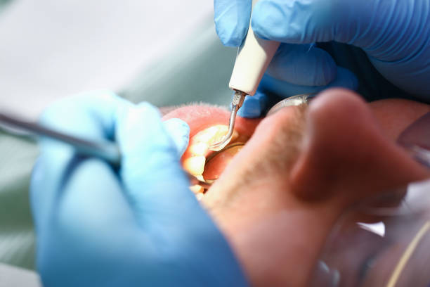 Best Dentist for Tooth Abscess  in Sawmills, NC